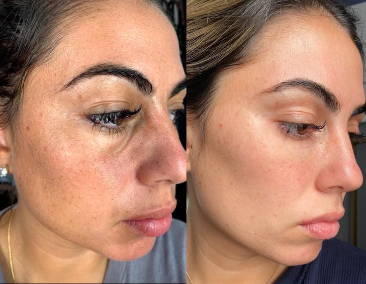Before and after - Pigmentation and even tone