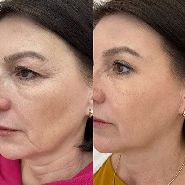 Before and after - Wrinkles around the eyes and mouth