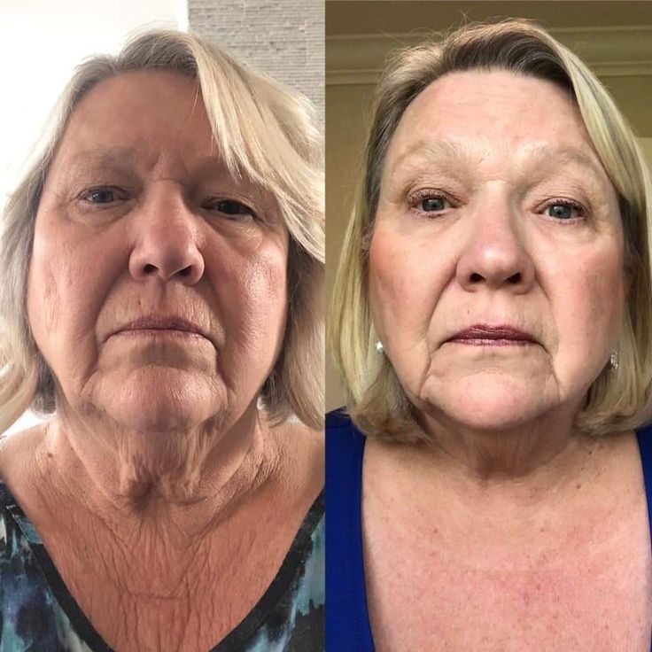 Before and after - Firmer neck skin