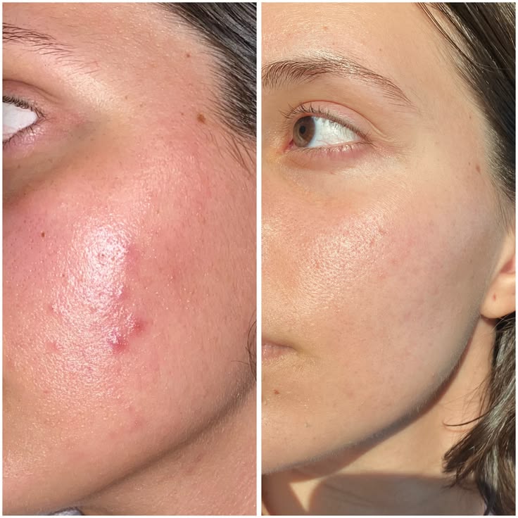 Before and after - Calmer redness and blemishes