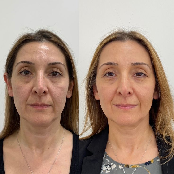 Before and after - Lifting and jawline definition