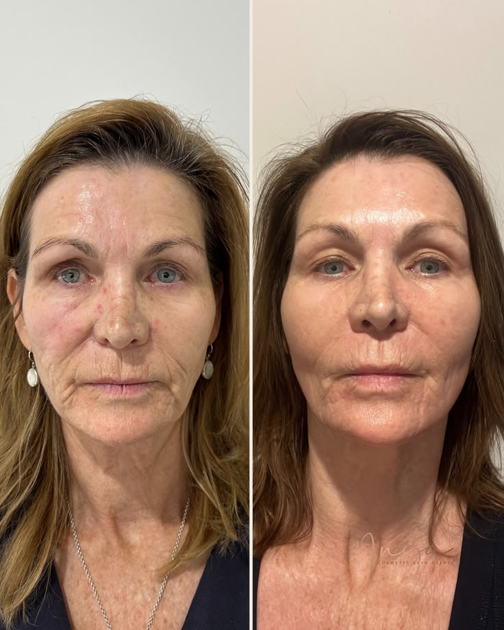 Before and after - Reduced wrinkles and radiance