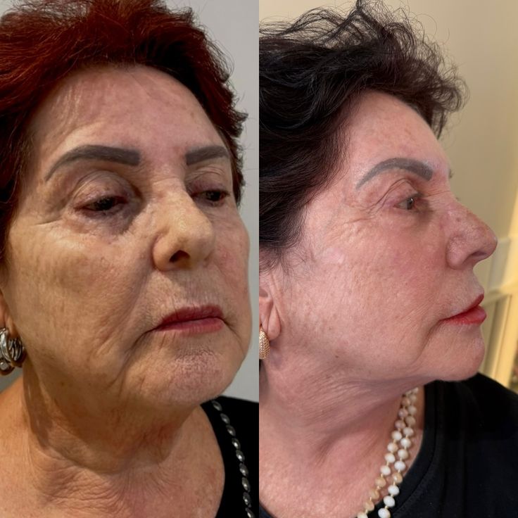 Before and after - Lifted cheek line
