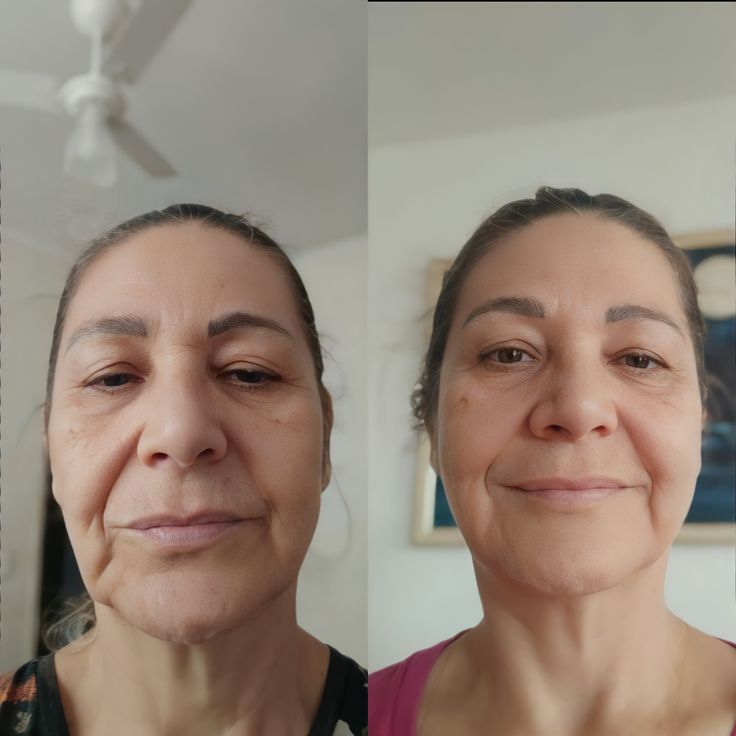 Before and after - Reduced fine lines