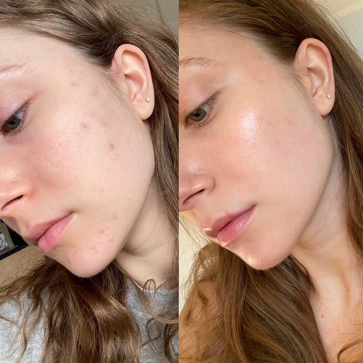 Before and after - Smooth, clear skin
